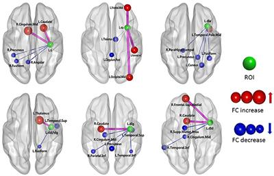 Functional Connectivity Differences in the Insular Sub-regions in Migraine without Aura: A Resting-State Functional Magnetic Resonance Imaging Study